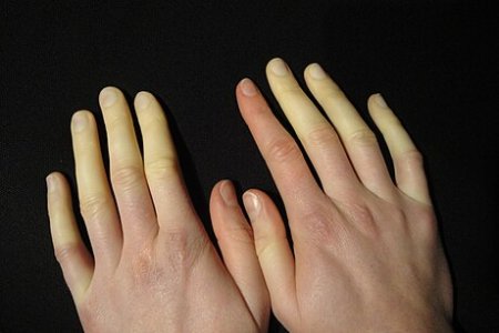 Raynaud-Syndrom.JPG